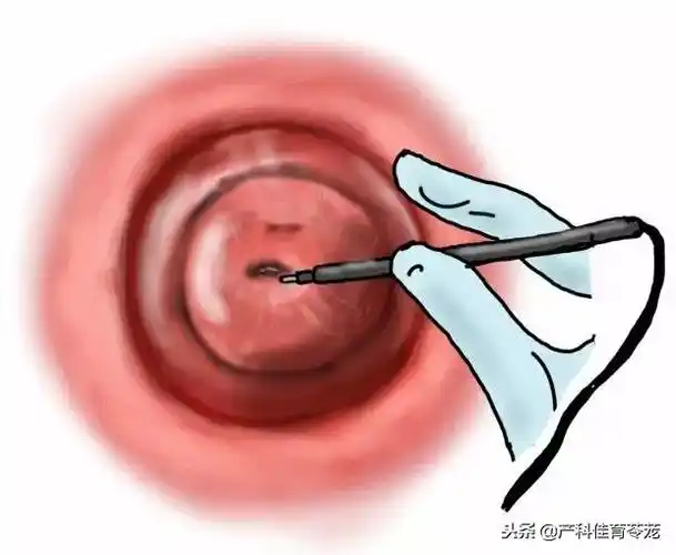 宫颈囊肿需要手术吗宫颈上的囊肿多数不需治疗