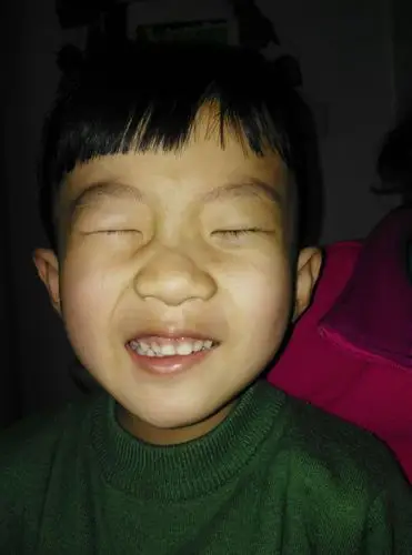 面瘫小朋友两例 ——焦春杰 随手笔记一篇于3月26日