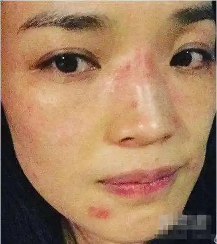 林志玲喝酒过敏周迅抽烟爆痘痘, 明星皮肤问题也吓人