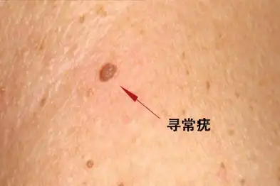 寻常疣和扁平疣症状有所区别.1.