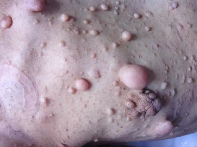 一例心梗病人吓人的皮肤赘生物