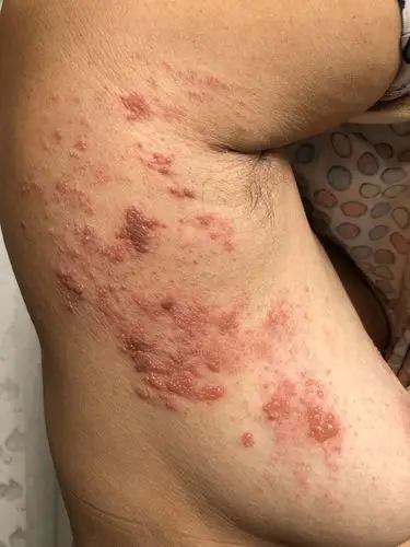 一分钟教您认识带状疱疹("生蛇","蛇串疮")_带状疱疹_症状表现_治疗