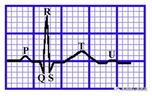 「临床实用心电图入门」第二讲:心电图导联,波形及临床价值