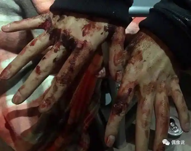 杨幂掉高空威亚,全身淤青,手臂被划,一道一道的血口子.