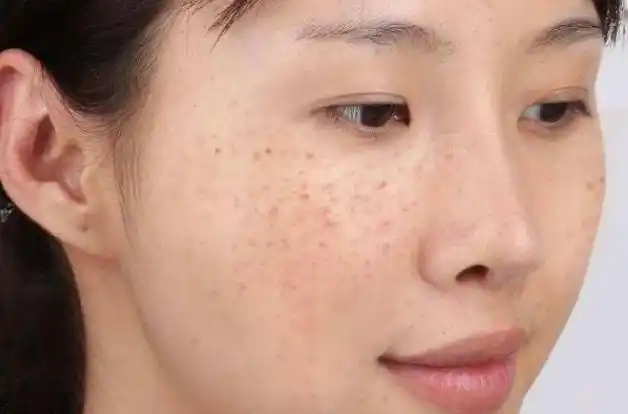 女人常吃白菜会加重面部斑点医生不想满脸斑4种蔬菜或少吃