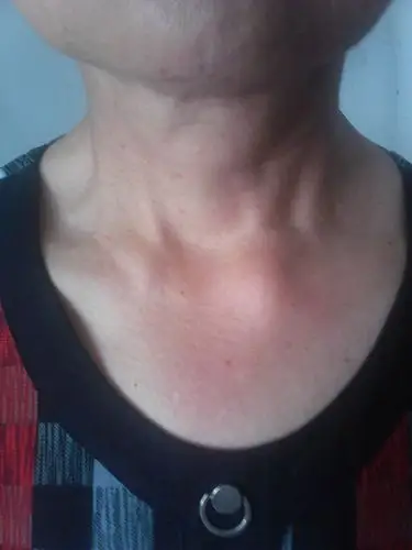 主要症状等): 左锁骨 锁骨头突出 左右明显不对称 一高一低 按压无