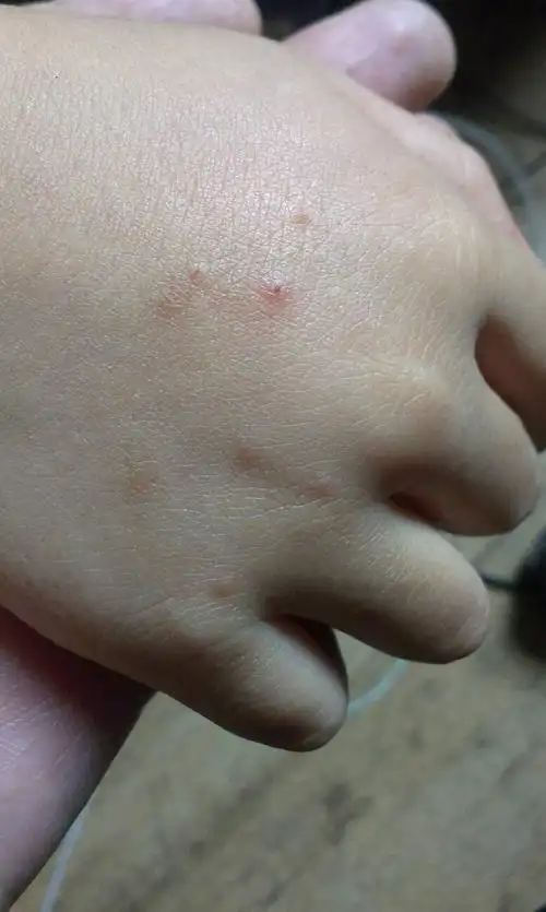 小孩子为什么老长像水痘的东西