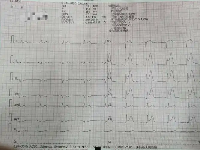st段抬高心电图分型 心电图st段抬高就是心梗?