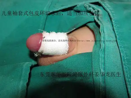 展开全部 ⑴阴茎根部皮下及两侧阴茎海绵体麻醉 ⑵尿道海绵体麻醉