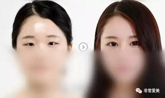 眼部综合整形对比图