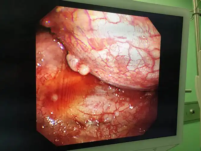 恶性胸水的克星——内科胸腔镜诊治胸腔积液新技术. - 美篇