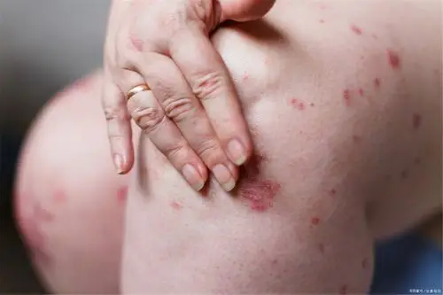 36岁女子长出小红点确诊肝癌医生这种菜吃太多赶紧撤