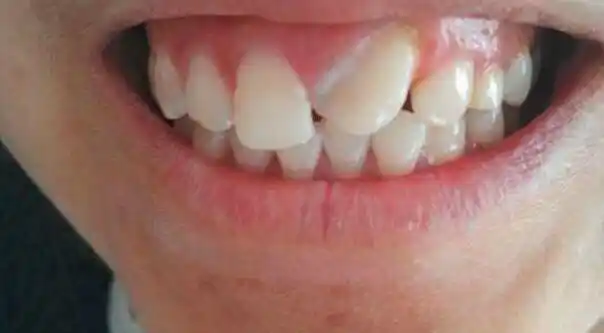 牙齿歪了怎么矫正