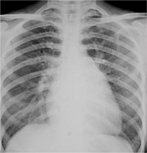 图2-22二尖瓣型心脏(梨型心)2.