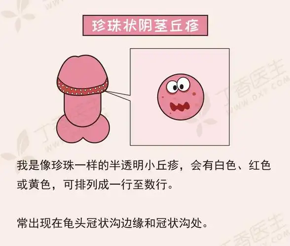 丁丁上长了小疙瘩!我是得性病了吗