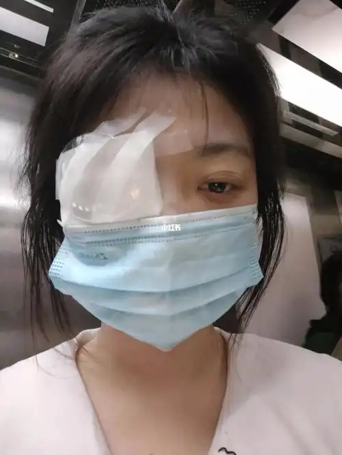 晶体植入手术第二天