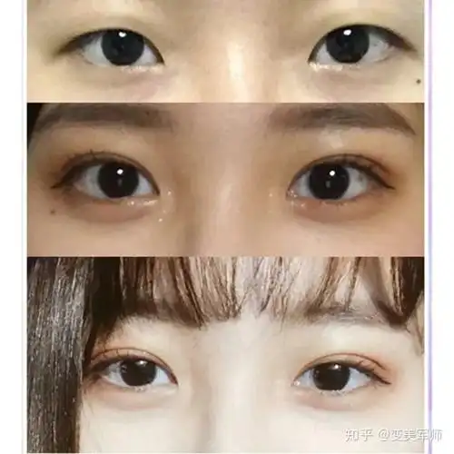 请大家帮我看看哪个开扇双眼皮好看吧