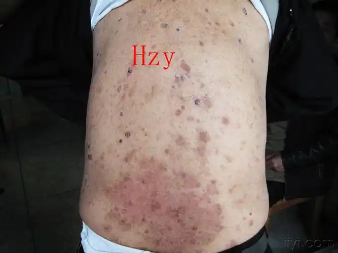 天疱疮病例分析躯干瘙痒起水疱一个半月
