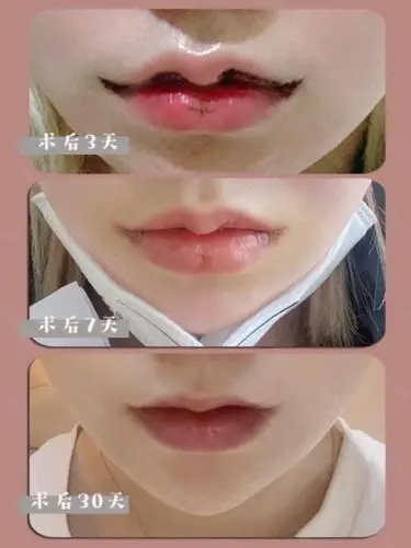 修复 微笑唇案例分析 微笑唇 脂肪填充修复案例_圈子-新氧美容整形