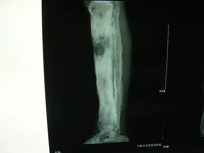 慢性骨髓炎伴骨外漏