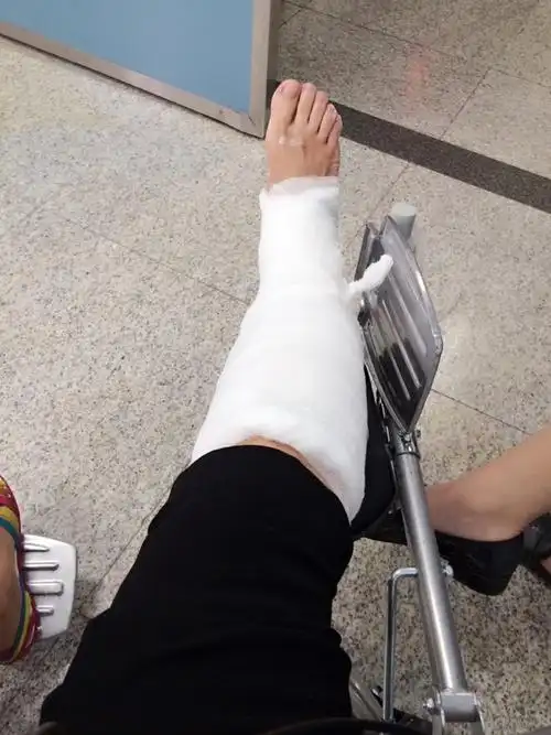 打完石膏再拍片子,看复位结果.闺女买了轮椅,伤脚可以平放.