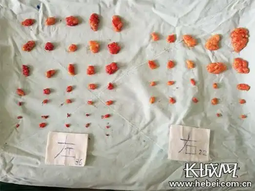 可发生于人体任何有脂肪的位置,两个或两个以上的称为多发性脂肪瘤