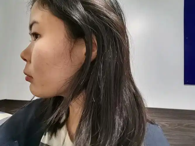 请问这是哪种类型的嘴凸呢侧脸太奇怪法令纹深没有人中如果要动手术的