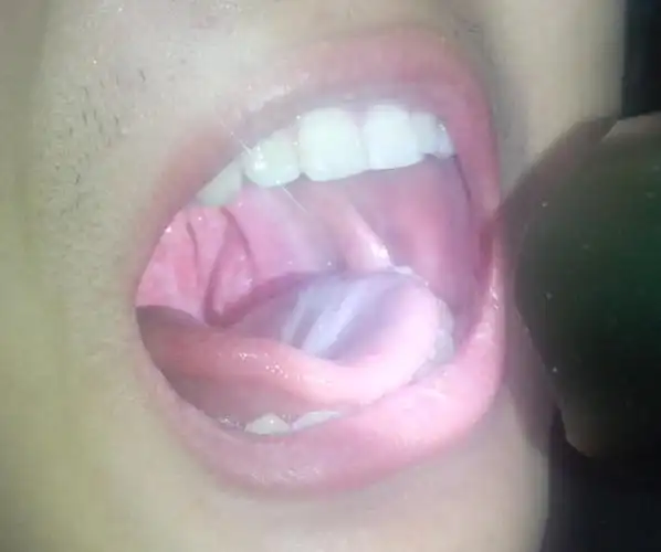 左侧扁桃体有白点,吞咽疼,没有其他症状,我该吃什么抗生素呢?