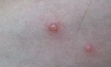 单纯疱疹及其治疗药物_生殖器