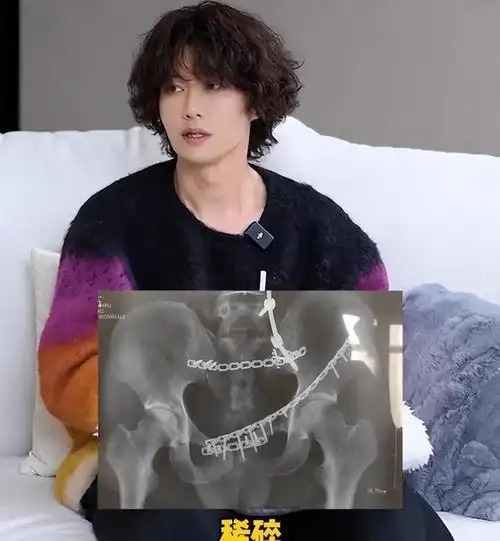 39岁的赵荀,从李二牛爆改成花美男,他的骨盆用3颗钉子挂在腰上