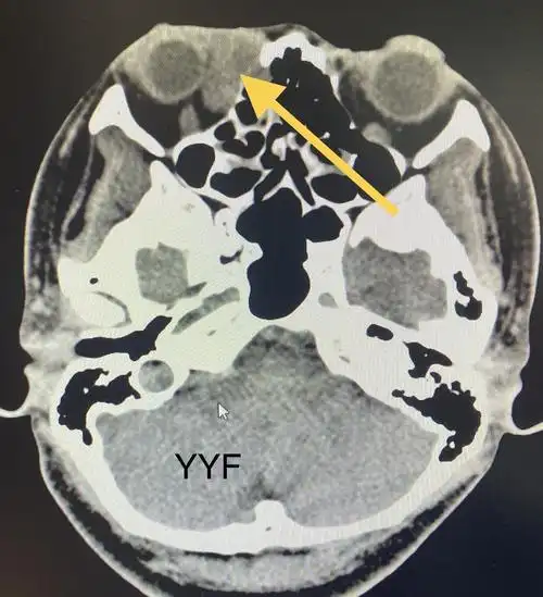 肿物位于泪囊区,有"炎症"表现,又是女性患者(泪道阻塞性疾病女性更好