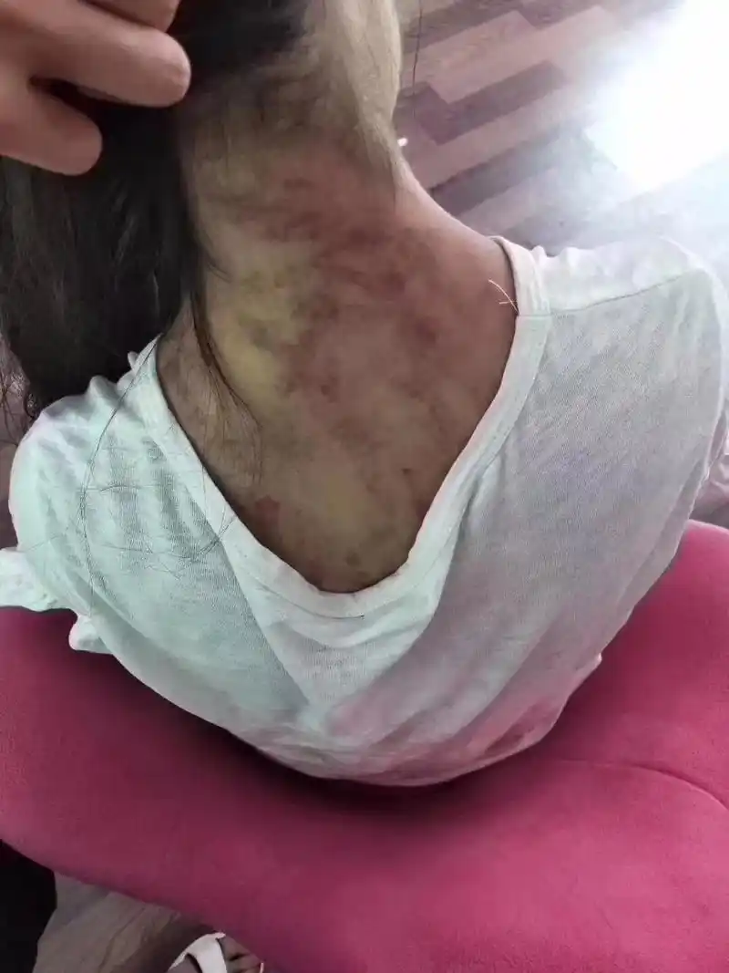 青海母亲燕志云虐女,滚油灌嘴纱线封口,被判7年,出狱挖坟泄愤