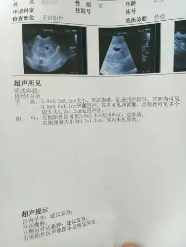 顺利抱娃!孕囊大小对照表"寿比南山"-第2张图片-龙骑博客