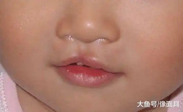 唇腭裂并不是比较罕见的病,这种疾病多数情况下在怀孕期间做孕检就