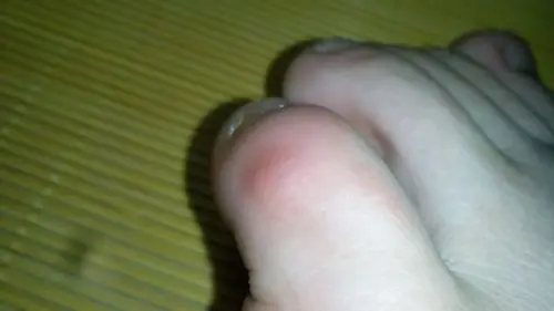 小脚趾边上长个硬疙瘩,不痛不痒,求诊断.谢谢.