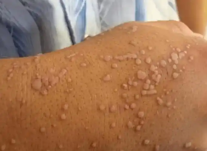 感染hpv诱发的疣体千万不能扣,越扣变得越严重感染hpv病毒诱发的疣体