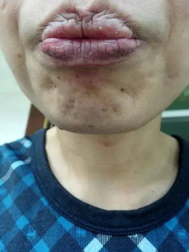 嘴唇经常起小脓包,好多年了怎么回事?