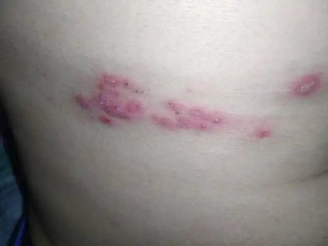 带状疱疹了,怎么回事,要多久可以好,用了抗病毒口服液和阿昔洛韦乳膏