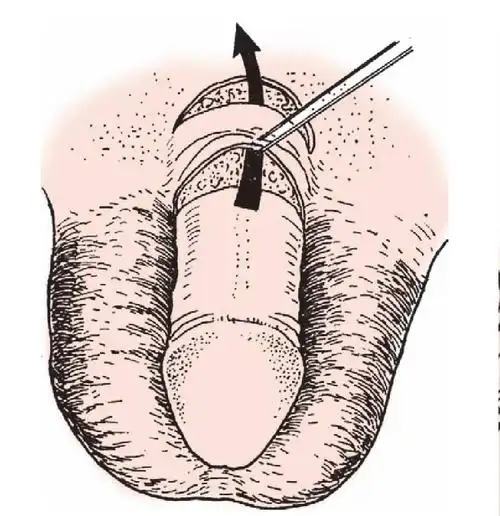 二阴茎正位切口矫形术