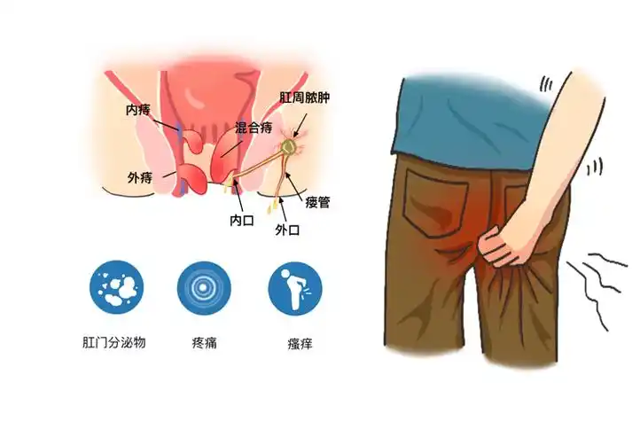 医生:肛门若常有4种不适,警惕癌症在靠近_症状_皮肤_检查