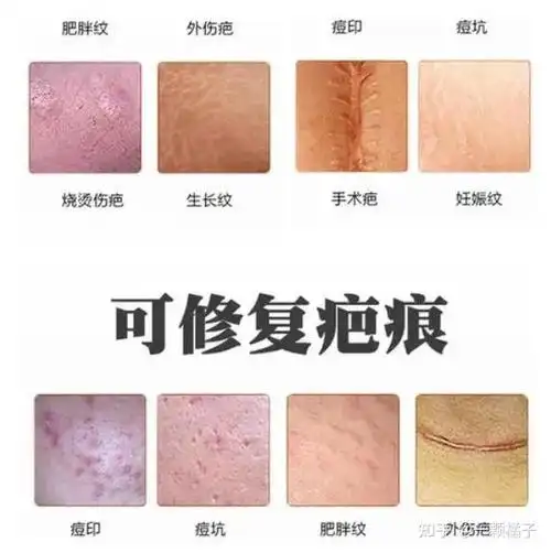 疤痕美学科普疤痕越长越大是什么原因造成的如何预防