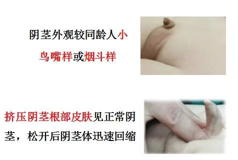 "关爱青少年,解决父母忧"--科室长期开展项目之隐匿阴茎矫治术