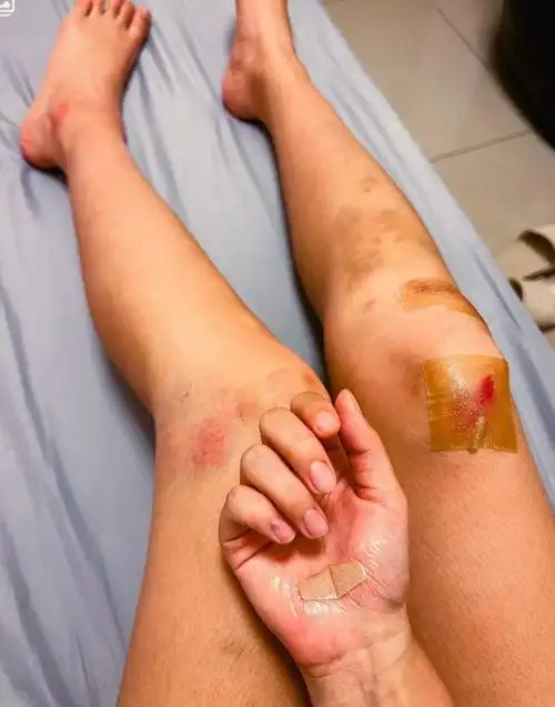 女主持杨净宇撞大货车受伤脚卡车底拔不出裤子磨破腿上全是血