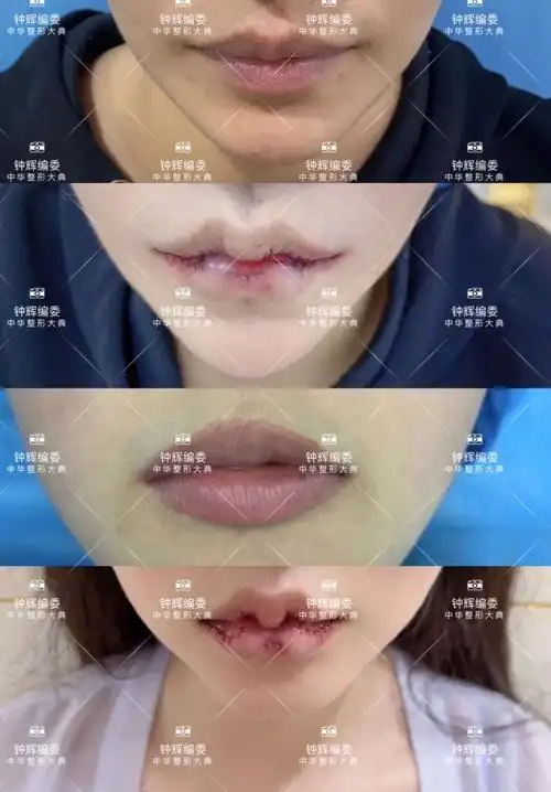 钟辉m唇整形术是手术好还是注射好丨科普篇