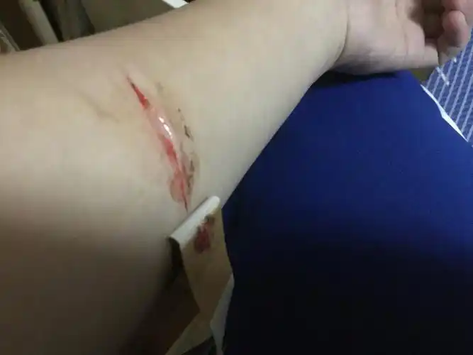 用美工刀在手臂上划了一条较小的口子不是很深过了一天了