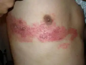 南京华肤医院 带状疱疹