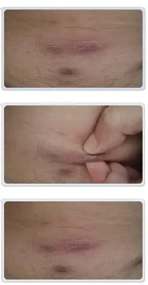 这个是疖病吗?一个好了,不久就来一个