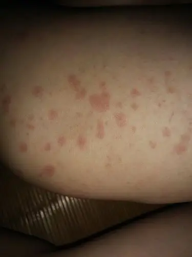 在高温环境下工作,今天下班,身上陆陆续续起满了红斑点,是什么原因