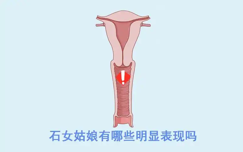 石女的症状是什么「石女的症状是什么意思」