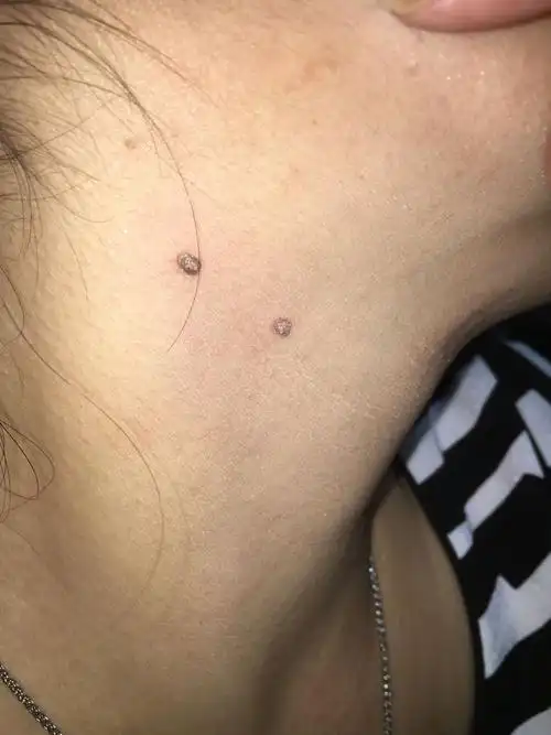 擅长:电脑/网络 向ta提问私信ta  展开全部   瘊子的医学名称为寻常疣